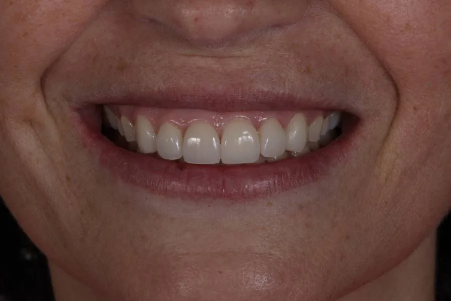 Sorriso finalizado com facetas de cerâmica E-max