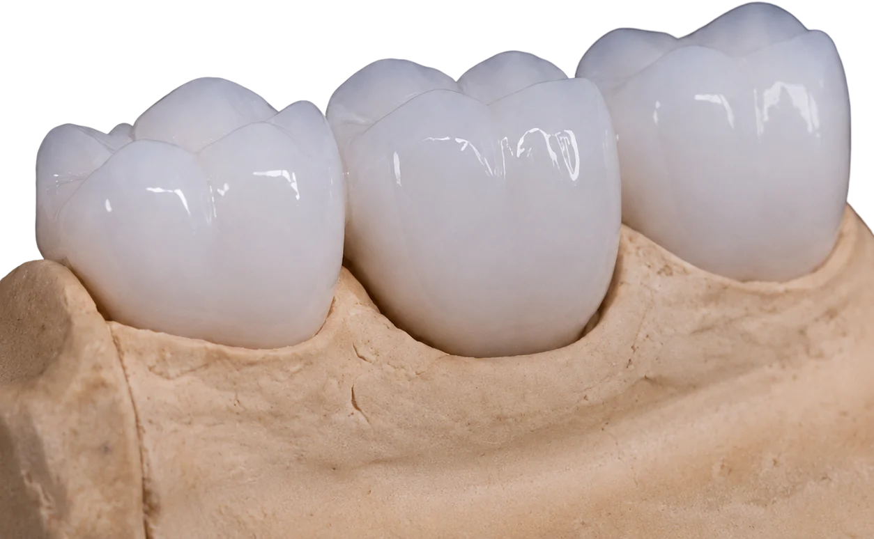 Coroas cerâmicas sobre modelo de trabalho